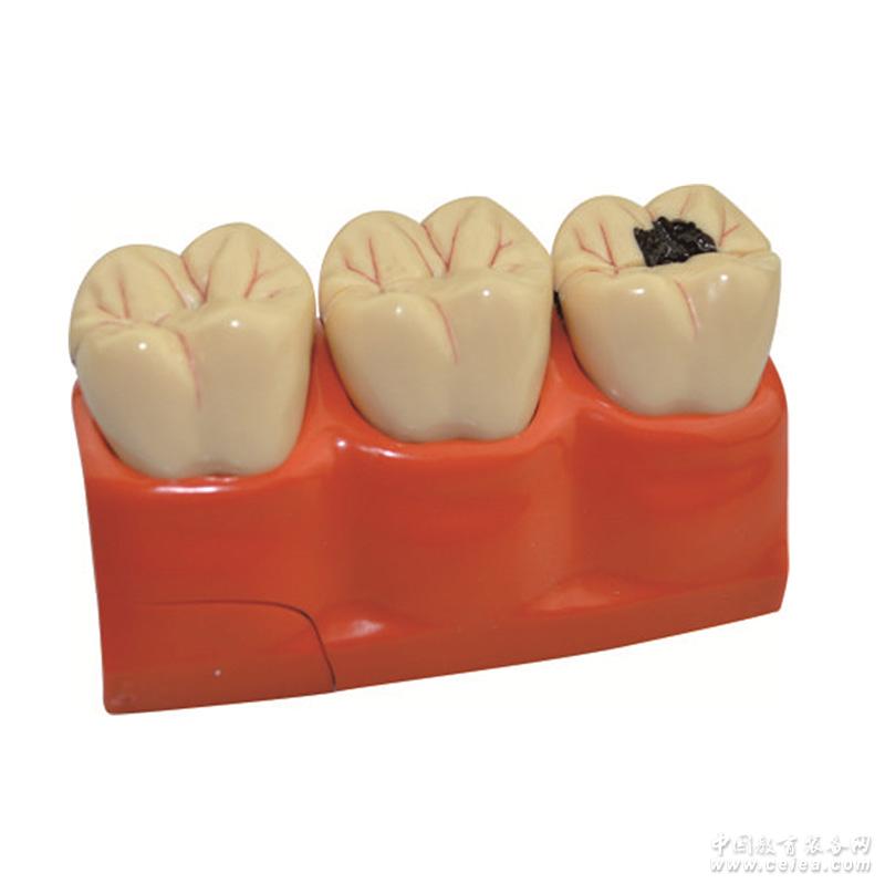 Modelofdecayedteeth龋齿模型
