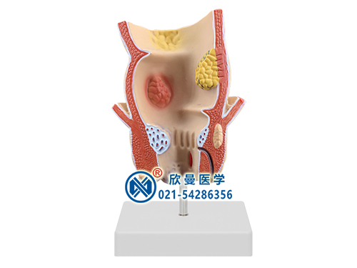 直肠病理模型
