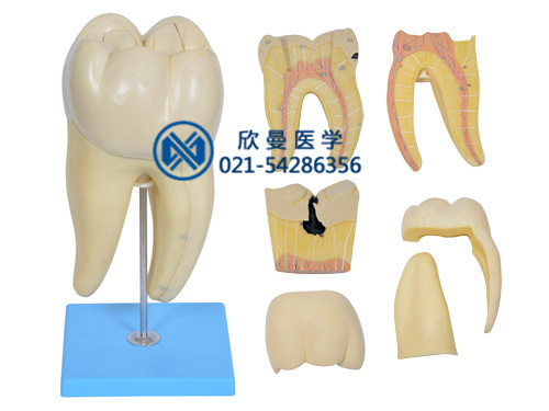 磨牙蛀牙解剖放大模型XM-911
